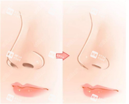 鼻翼缩小整形手术 鼻翼缩小整形手术