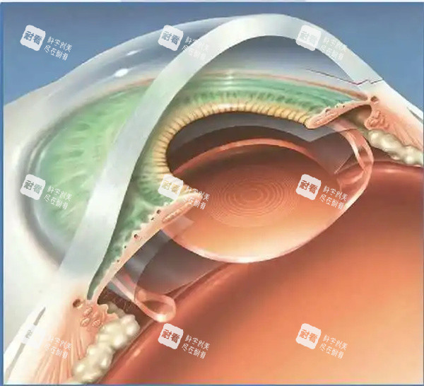 近视眼眼睛图片