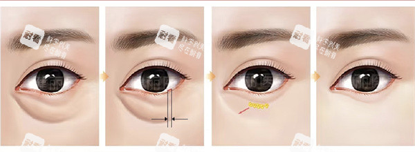 不开刀祛眼袋 不开刀祛眼袋