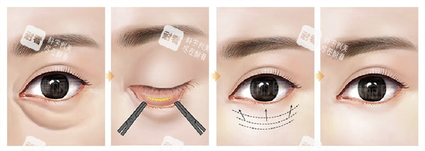 内切祛眼袋 内切祛眼袋