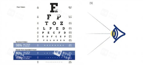 全光塑视力检查