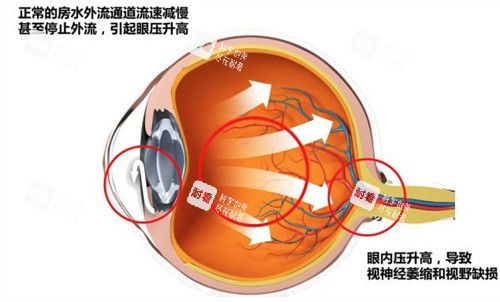什么是急性闭角型青光眼 什么是急性闭角型青光眼