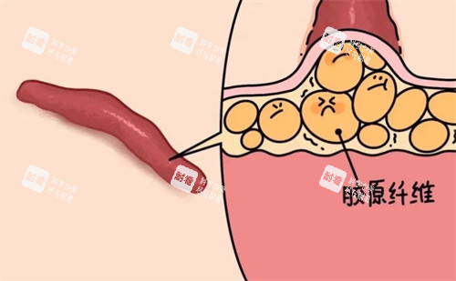 疤痕的形成原因