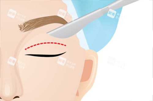 割双眼皮卡通图