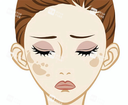 祛斑治疗卡通图片