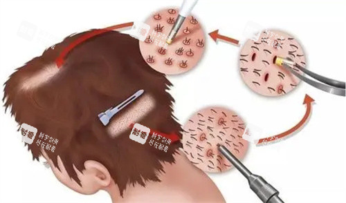 南岗区长江路瑞丽美利丝植发医院13年经验值不值？真实结果大揭秘！