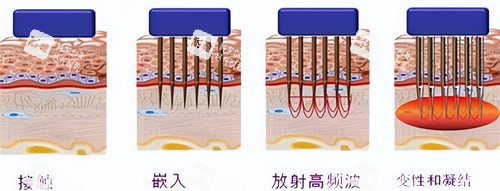 黄金微针操作过程
