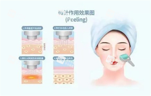 黄金微针作用图