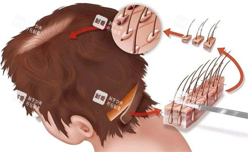 毛囊移植部位演示图 毛囊移植部位演示图