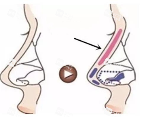 分段式隆鼻示意图
