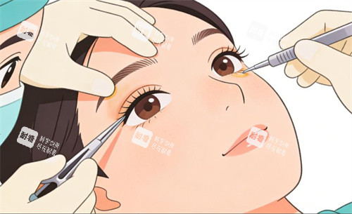 双眼皮修复卡通动画图 双眼皮修复卡通动画图