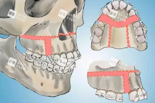 正颌手术示意图 正颌手术示意图