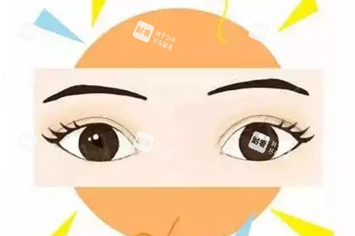成功双眼皮示意图 成功双眼皮示意图