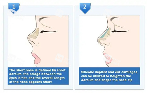 朝天鼻矫正过程