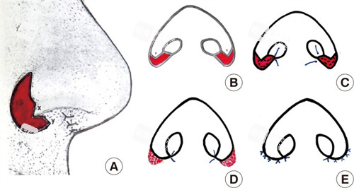 鼻翼缩小手术部位