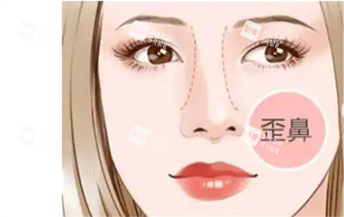 歪鼻修复