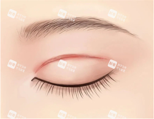 双眼皮肉条疤痕图 双眼皮肉条疤痕图