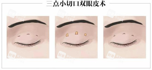 三点定位双眼皮的操作步骤 三点定位双眼皮的操作步骤