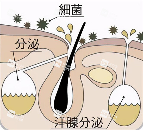 腋臭是怎么形成的 腋臭是怎么形成的