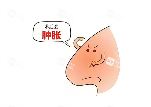 隆鼻术后肿胀动画图