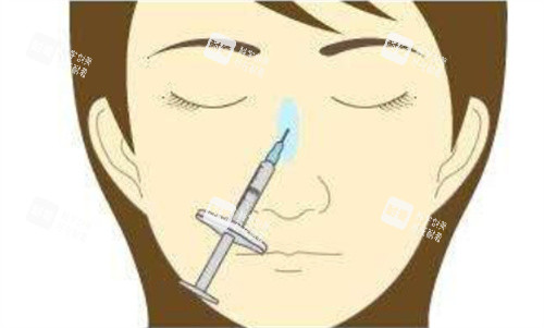 注射隆鼻正面