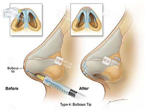 玻尿酸注射隆鼻