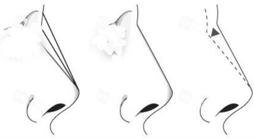 鼻梁角度调整过程展示图