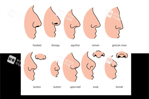 鹰钩鼻和朝天鼻矫正