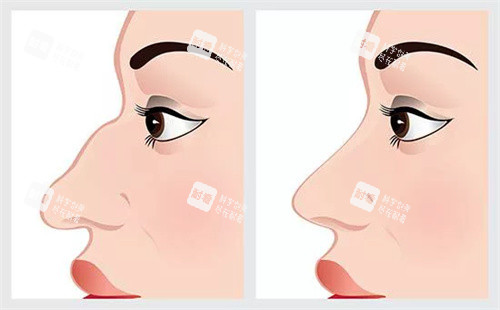 驼峰鼻鼻部矫正对比