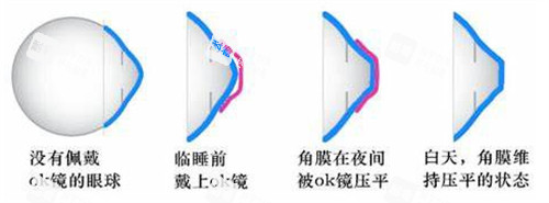 角膜塑形镜多少钱