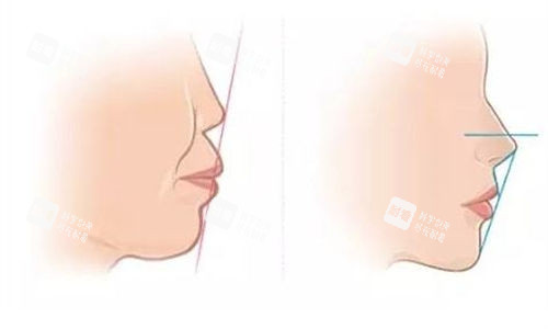 鼻基底矫正前后对比示意图