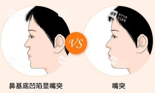 鼻基底凹陷嘴凸示意图