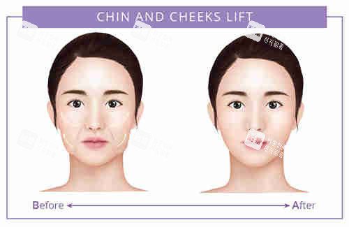 面部提升对比图 面部提升对比图