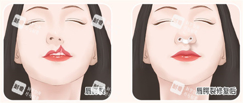 唇腭裂修复