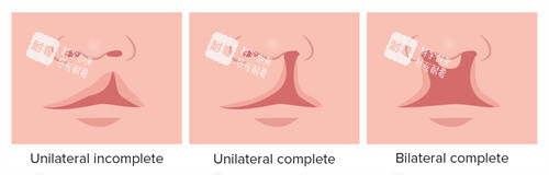 唇裂和唇腭裂不同程度