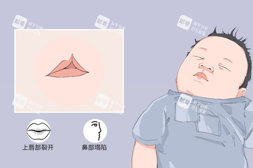 唇腭裂症状图