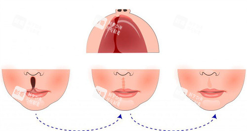唇裂修复过程 唇裂修复过程