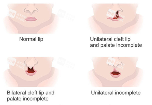 唇裂修复图片 唇裂修复图片