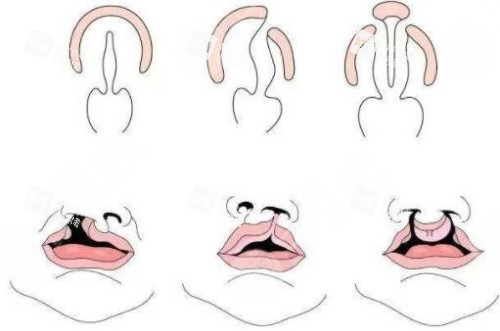 唇裂鼻修复结构图 唇裂鼻修复结构图