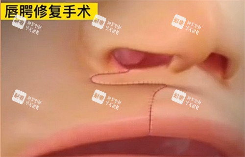 唇裂修复手术即刻形状