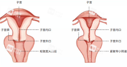 阴道紧缩术施术位置图解