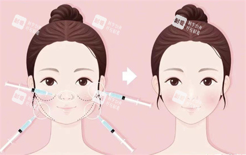 针剂注射打造幼态脸 针剂注射打造幼态脸