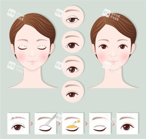 切开双眼皮手术前后对比和过程 切开双眼皮手术前后对比和过程