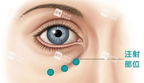 泪沟注射部位示意图 泪沟注射部位示意图