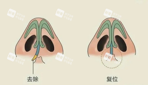 鼻子假体歪斜复位示意图