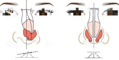 歪鼻修复矫正示意图 歪鼻修复矫正示意图