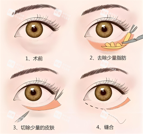 外切祛眼袋术原理 外切祛眼袋术原理