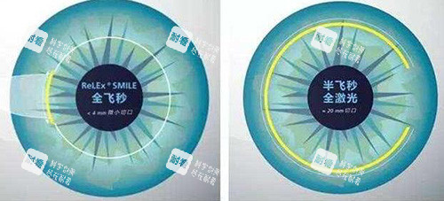 全飞和半飞手术对比卡通图