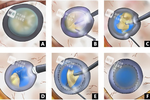 超声乳白内障手术 超声乳白内障手术