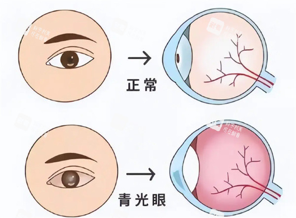 青光眼卡通图片
